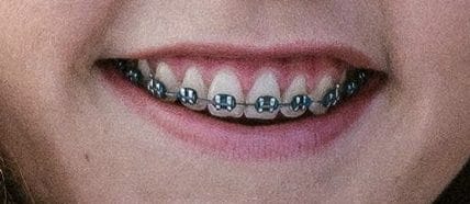 Genessa Panainte KFO festsitzende Apparatur gerade Zähne Brackets Kieferorthopädie festsitzende Apparatur
