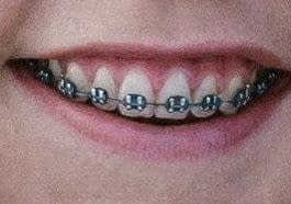 Genessa Panainte KFO festsitzende Apparatur gerade Zähne Brackets Kieferorthopädie festsitzende Apparatur